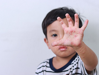 Hand, Foot, and Mouth Disease: Symptoms and Treatments