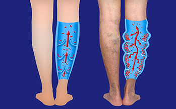 Varicose veins on a female senior legs. The structure of normal and varicose veins. Concept of dry skin, old senior people, varicose veins and deep vein thrombosis or DVT
